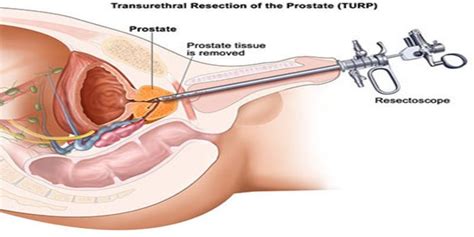 Holep An Efficient Procedure To Treat Enlarged Prostate