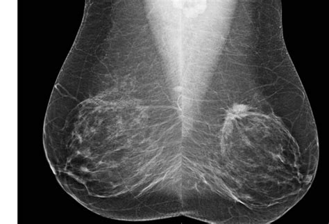 risk based screening misses breast cancers in women in their forties