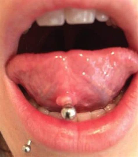 red bump  tongue