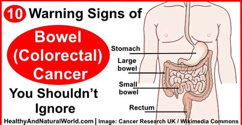10 Warning Signs Of Bowel Colorectal Cancer You Shouldn’t Ignore