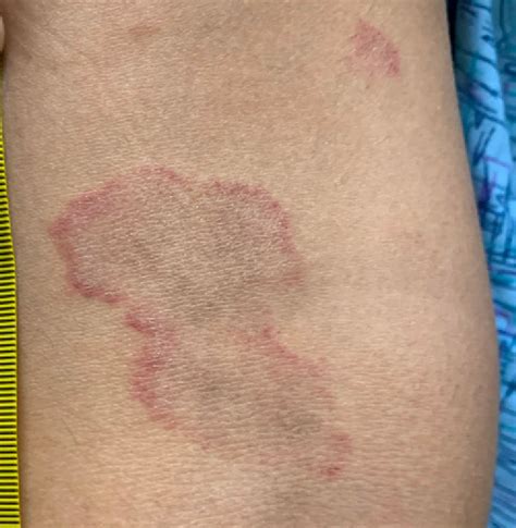 adolescent female  rash   arms  posterior legs mdedge pediatrics