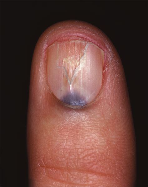 a blue gray subungual discoloration—quiz case anesthesiology jama