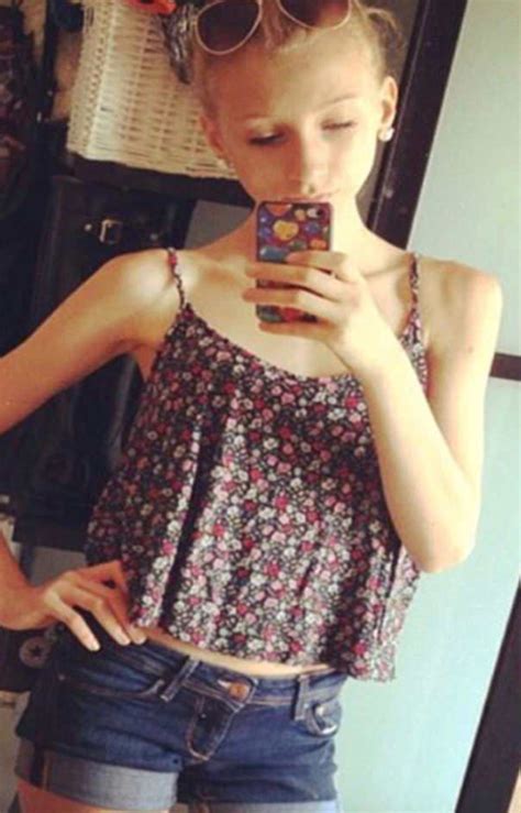 Anorexic Teen Who Lived On Nothing But Chewing Gum And Sparkling Water