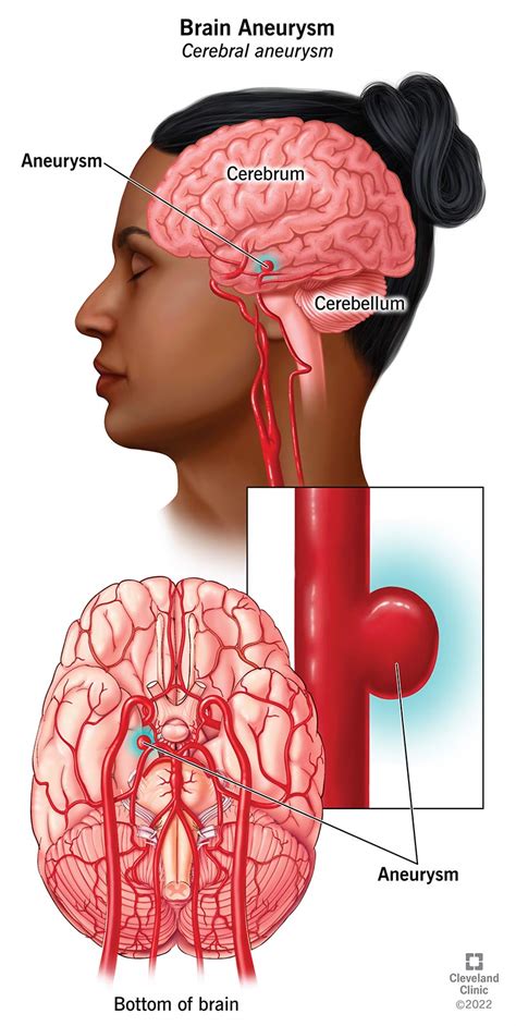 brain aneurysm     symptoms treatment