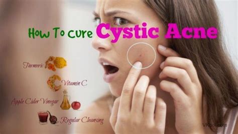 How To Cure Cystic Acne Fast Naturally 7 Tips