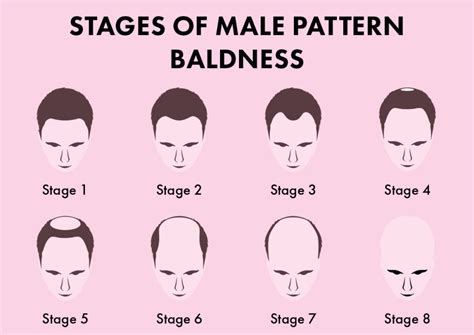 male pattern baldness causes prevention and the best treatments blog
