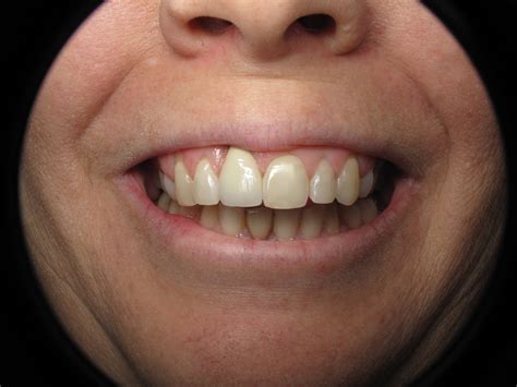 dental implant   deep tooth  long ramsey  amin dds