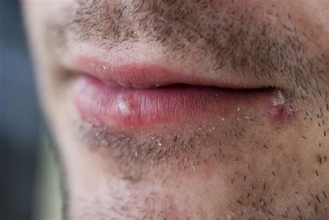 oral herpes the symptoms and cure dentist says
