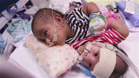 Conjoined Twins Take Big Step Towards Separation Sugery