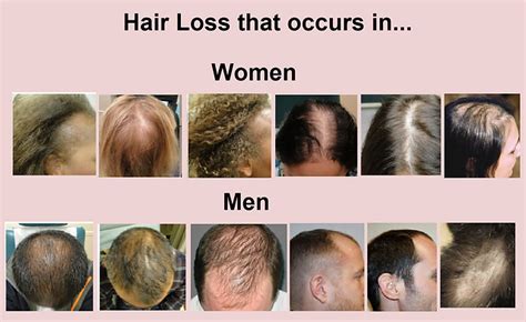 top  image signs  hair loss thptnganamsteduvn