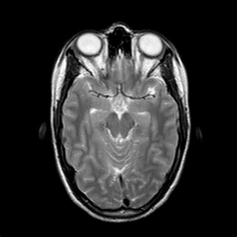 Multiple Sclerosis With Active Lesions Radiology Case