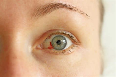corneal laceration  symptoms diagnosis  treatment accuspire