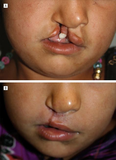 addressing challenges of cleft lip and palate deformity in afghanistan