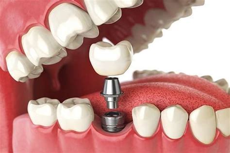 quanto custa um implante dentário de um dente consulta ideal