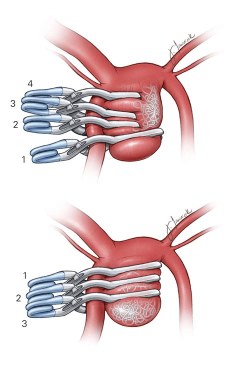 clip ligation  previously coiled aneurysm  neurosurgical atlas