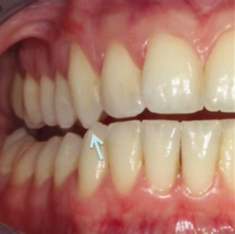 canine guidance  dentistry news dentagama