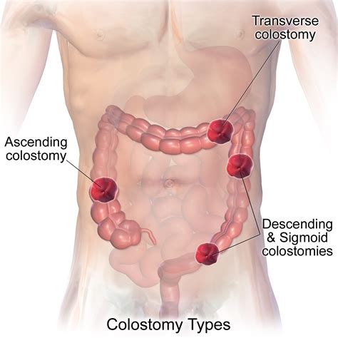 Ostomy Help Ostomy Diet Tips For Ileostomy And Colostomy