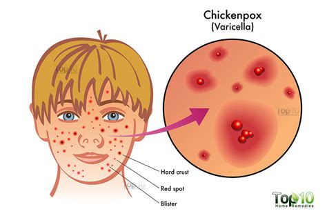 Chicken Pox Herpes Varicella Zoster Apex Dermatology And Skin Surgery