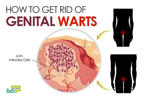 how to get rid of genital warts health herpes remedies genital herpes herpes treatment