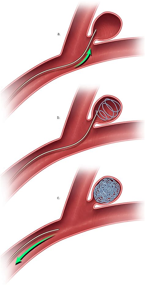 brain aneurysm  symptoms warning signs treatment