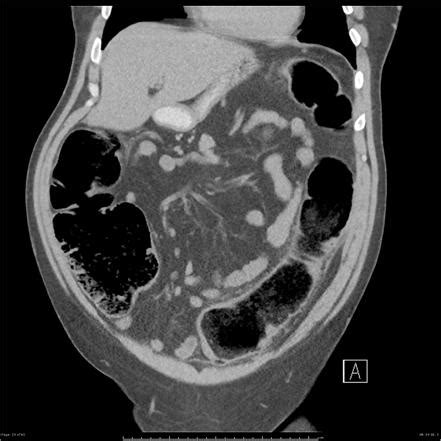 large bowel obstruction radiology reference article radiopaediaorg