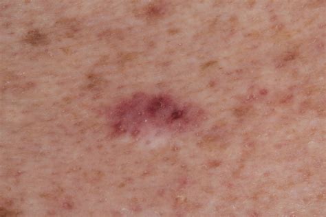 Effects Of Curettage After Shave Biopsy Of Unexpected Melanoma A