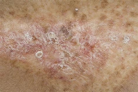skin cancer on leg pictures 22 photos and images