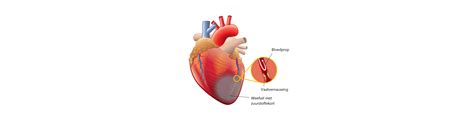 hartinfarct trombosestichting