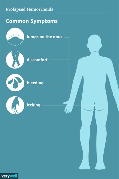 prolapsed hemorrhoids symptoms causes and treatment