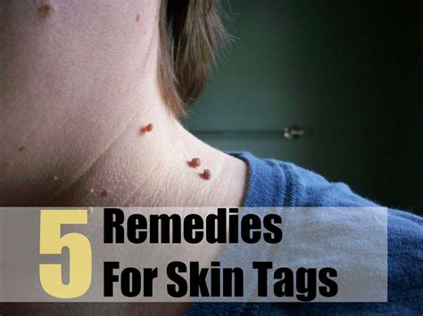 5 remedies for skin tags home remedies for skin skin tag removal