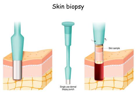 skin biopsies   expect thumbay university hospital