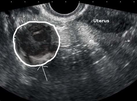 [figure Right Tuboovarian Abscess Image Courtesy S Bhimji Md
