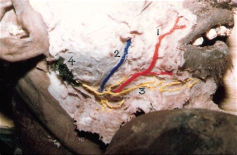 marginal mandibular branch of the facial nerve arising from the download scientific diagram