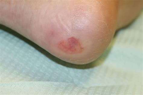 diabetic neuropathy wounds  foot pain solutions