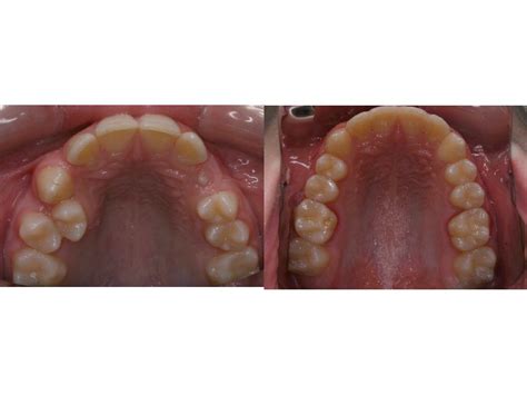 crowding non extraction treatment photos orthodontics