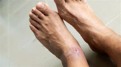 diabetic foot ulcers  stages  treatment goodrx