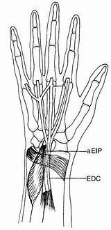 Extensor Tendon Hand Proprius Indicis Orthobullets Anomalous sketch template