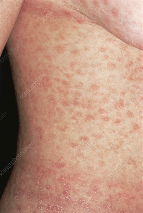 Syphilis Rash Secondary Syphilis Presenting With Acute Unilateral