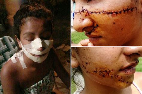 teenage girl left disfigured after jealous rivals mutilate her for being too pretty mirror