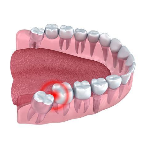 wisdom teeth removal cardinia dental