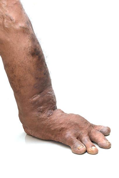 Ugly Feet Banque D Images Et Photos Libres De Droit Istock