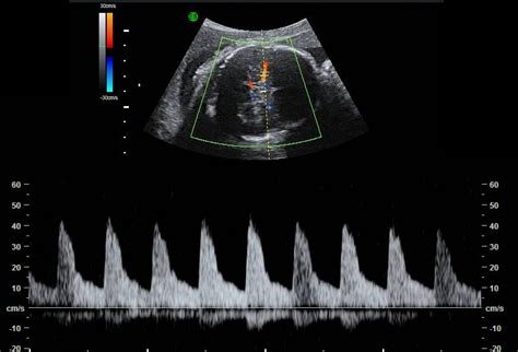 growth  doppler ultrasound maternal fetal medicine