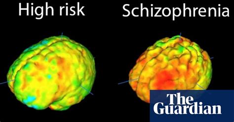 radical new approach to schizophrenia treatment begins trial society