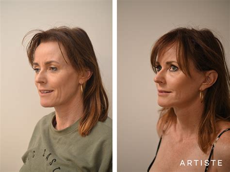 Deep Plane Facelift Before And After Artiste Plastic Surgery