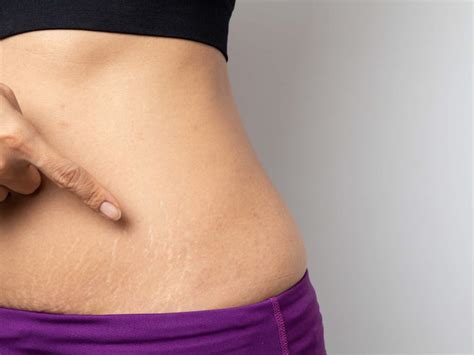 prevent stretch marks  losing weight  times  india
