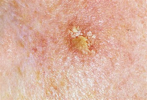 early skin cancer early signs  skin cancer skin cancer pictures