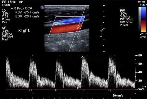 normal cca spectral waveform  flow continues   cardiac