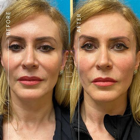 pdo threads  surgical facelift houston tx lush rx med spa