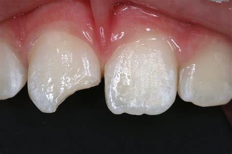 white fillings frequently asked questions composite fillings