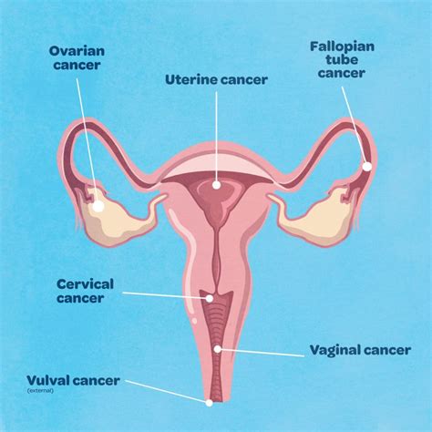 5 warning signs women should not ignore cancercuretoday